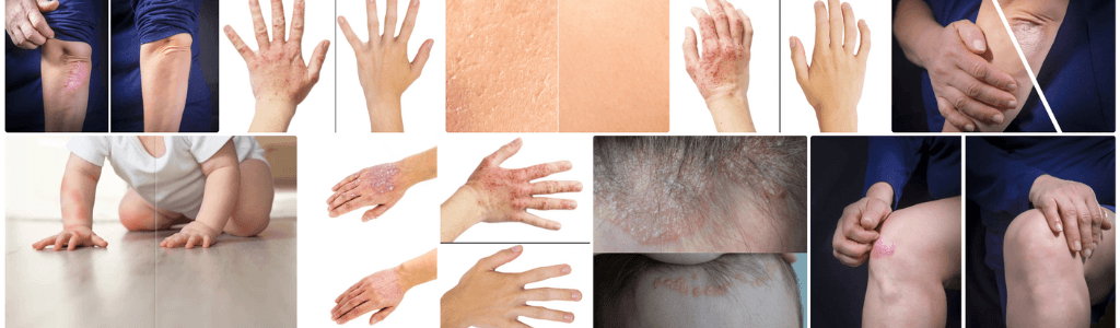 Eczema Treatment