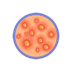 Bacterial Infections