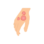 Dermatitis Solutions